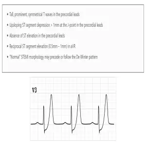 ECG de Winters T Waves